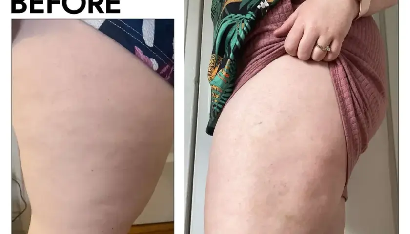 Przed i po: widoczna poprawa skóry na udach, zmniejszenie widoczności co to cellulit.