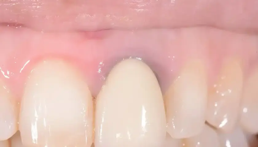 Dettaglio di denti con una corona e gengive rosa, con alcune aree che mostrano sfumature di gengive nere.