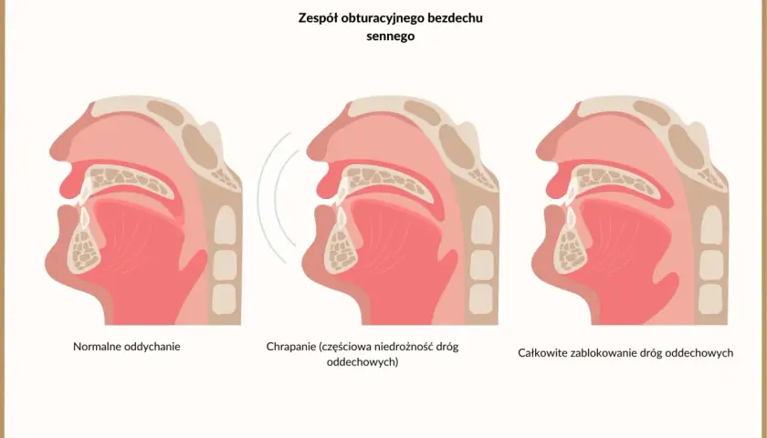 Ilustracja pokazuje przekrój dróg oddechowych. Od normalnego oddychania, przez częściową niedrożność powodującą chrapanie, aż do całkowitego zablokowania, które jest objawem bezdechu sennego.