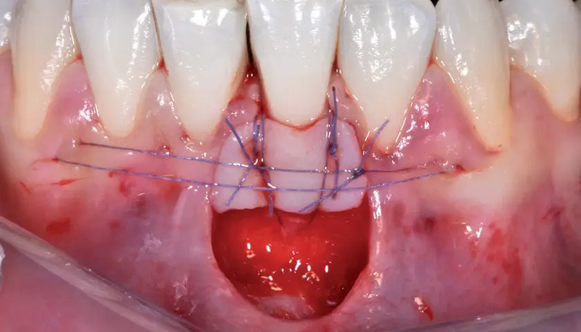 Primo piano di un innesto gengivale con suture viola che fissano il tessuto.