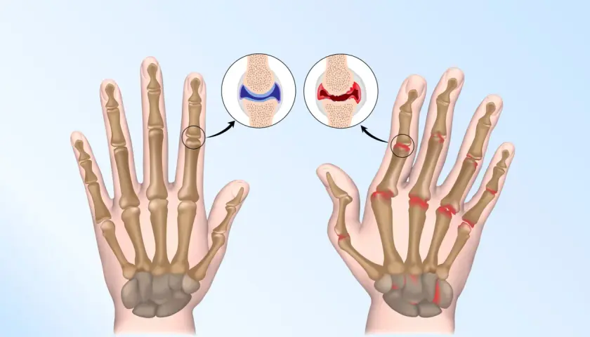 Vergleich von gesunden und entzündeten Gelenken der Hand, die chronische Polyarthritis zeigen.