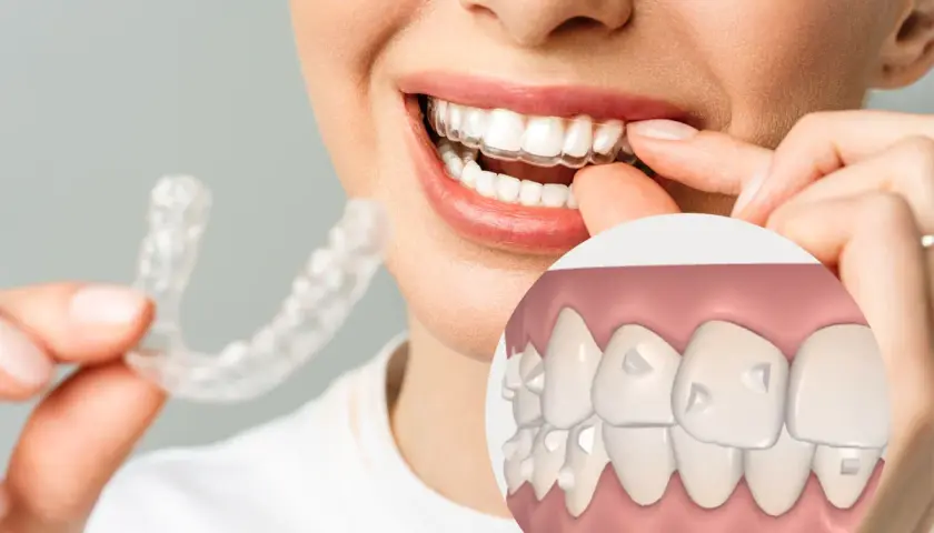 Una mujer sonríe mientras se coloca un alineador transparente. Un primer plano muestra dientes con pequeños ataches, revelando para que sirven los ataches: guiar el movimiento dental.