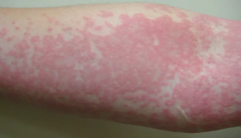Roter, fleckiger Hautausschlag am Arm, möglicherweise ein Symptom von Corona.