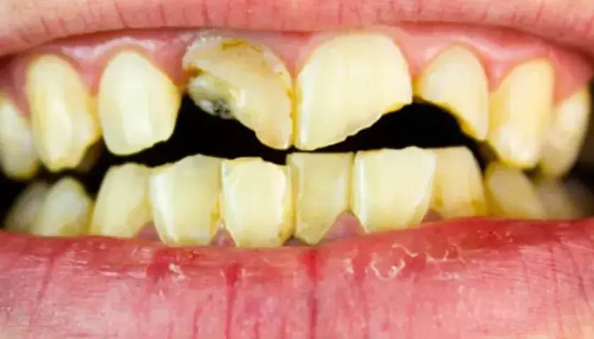 Dientes amarillentos y rotos, con caries visibles. Un triste reflejo de los dientes de drogadicto, que muestran el devastador efecto de las adicciones en la salud bucal.