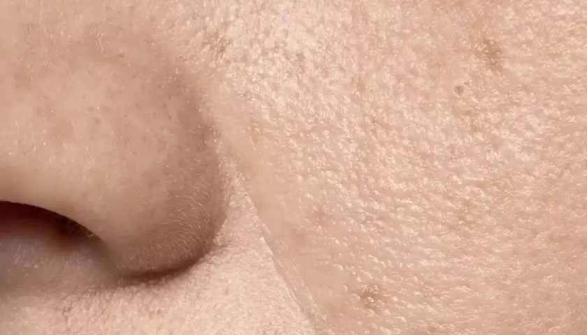 Primer plano de la piel, mostrando la textura y los poros visibles. Se aprecian pequeñas imperfecciones y la delicada superficie.