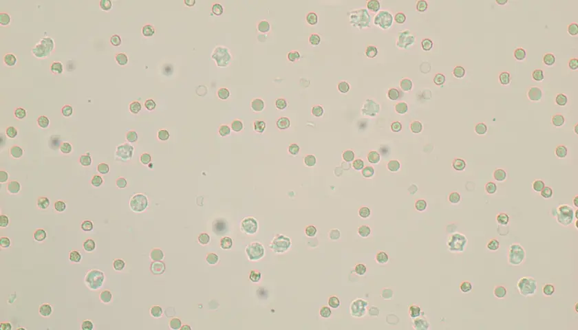 Mikroskopowy obraz moczu z licznymi erytrocytami świeżymi, niektóre z nich mają nieregularne kształty, co może wskazywać na ich obecność w drogach moczowych.