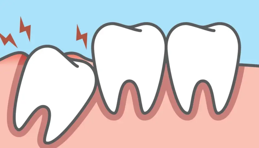 Dente incapsulato che fa male, con fulmini rossi che indicano dolore e gengiva infiammata.