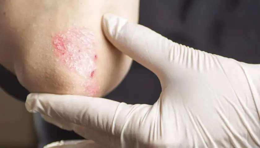 Gomito di un bambino con psoriasi, esaminato da una mano guantata.