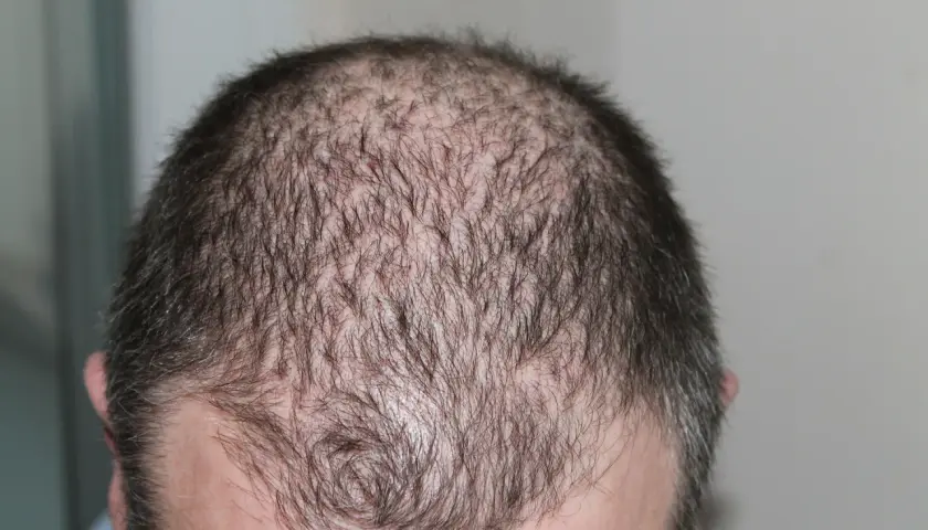 Huvud med tunt hår, visar fläckar av håravfall. Möjlig indikation på alopecia areata behandling.