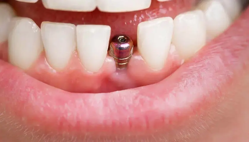 Metalowy implant zęba wystaje z dziąsła między białymi zębami, gotowy na odbudowę.
