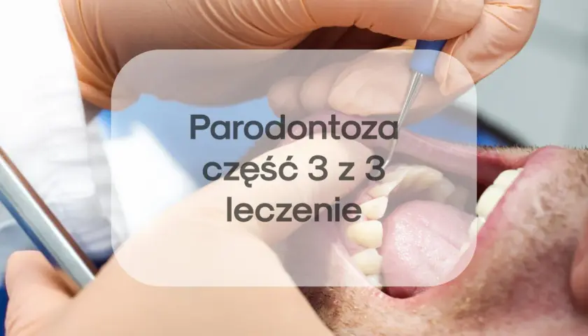 Leczenie paradontozy laserem to nowoczesna metoda. Sprawdź, jaka jest laserowe leczenie paradontozy cena i jak przebiega zabieg.