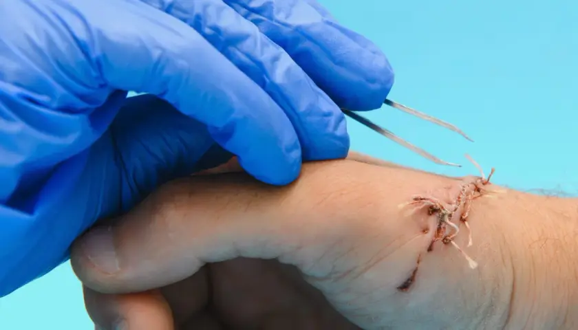Main d'un professionnel en gant bleu utilisant une pince pour enlever un point de suture sur une main blessée.