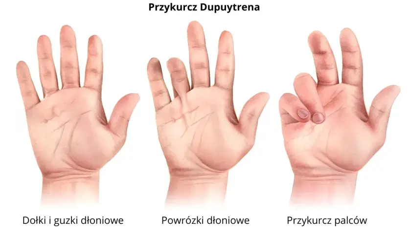 Trzy dłonie pokazujące postęp przykurczu Dupuytrena: zdrowe, z powrózkami i z przykurczem palców.