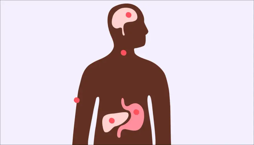 Illustration av en mänsklig silhuett med markerade organ som hjärna, hals, mage och lever. Röda prickar indikerar potentiella problemområden, vilket väcker frågan: kan man få feber av stress?