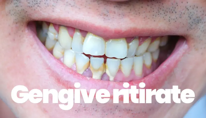 Denti con tartaro e gengive ritirate. Scopri le vitamine per gengive ritirate e migliora la tua igiene orale.