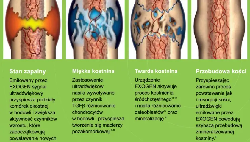 Ilustracje pokazują etapy zrostu kości: stan zapalny, miękką i twardą kostninę, przebudowę kości. EXOGEN przyspiesza zrost kości po złamaniu.