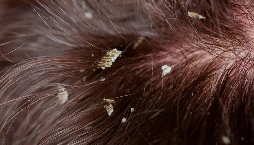Primer plano de cabello castaño con escamas blancas visibles, indicando descamación del cuero cabelludo.