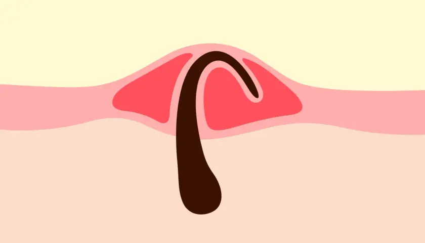 Illustration d'un bouton, montrant un poil pubien courbé sous la peau.