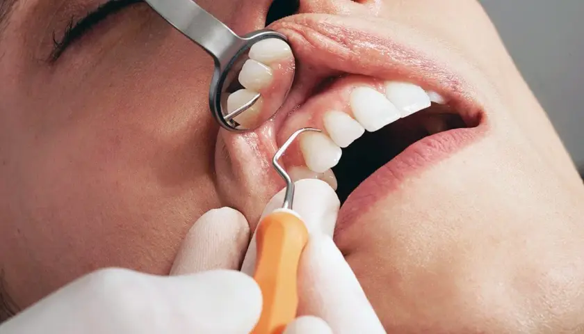 Dettaglio di un intervento di curettage gengivale, con strumento dentale che pulisce la zona tra dente e gengiva.