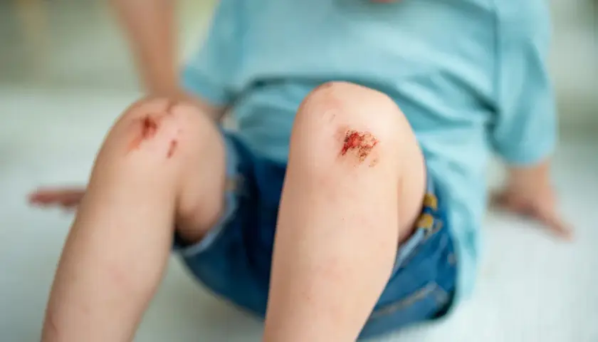 Dziecko z otartymi kolanami. Wczesne objawy tężca mogą obejmować drobne skaleczenia i otarcia, które wymagają uwagi.