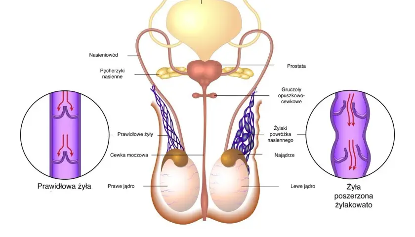 Ilustracja anatomiczna męskiego układu rozrodczego z widokiem na jądra i powrózek nasienny, porównująca prawidłowe żyły z poszerzonymi.