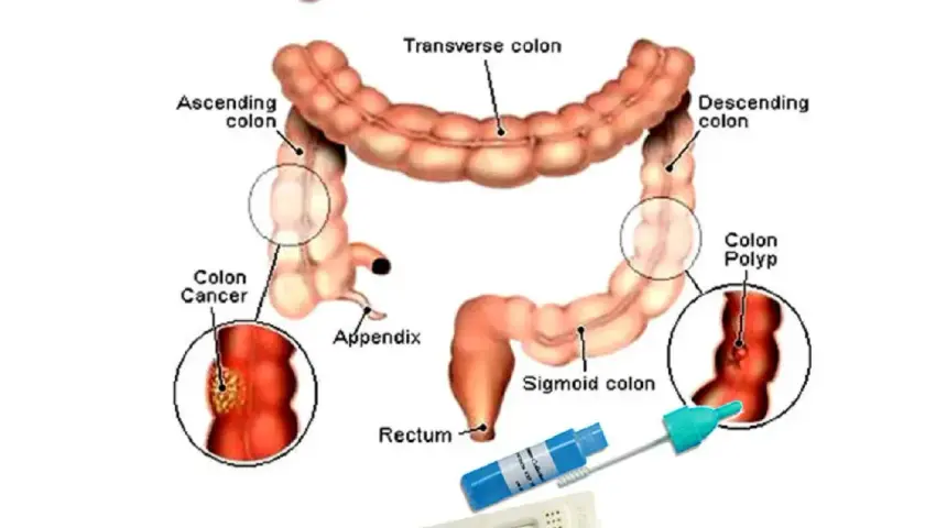 Illustrazione del colon con indicazioni su cancro, polipi e test per sangue occulto nelle feci.