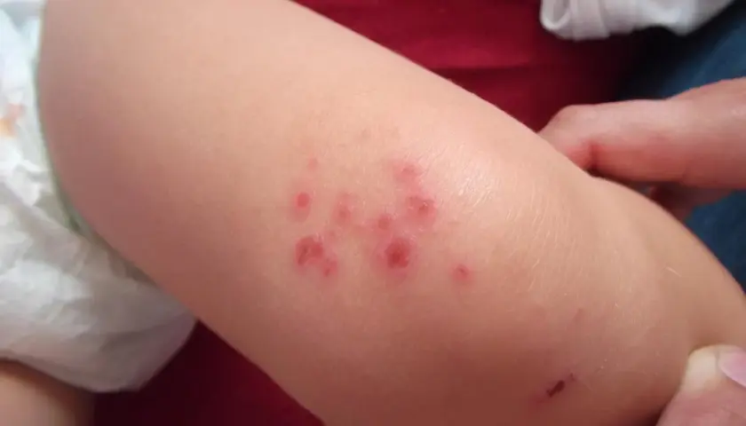 Lesioni cutanee rosse e pruriginose su un braccio di bambino, indicative di impetigine.