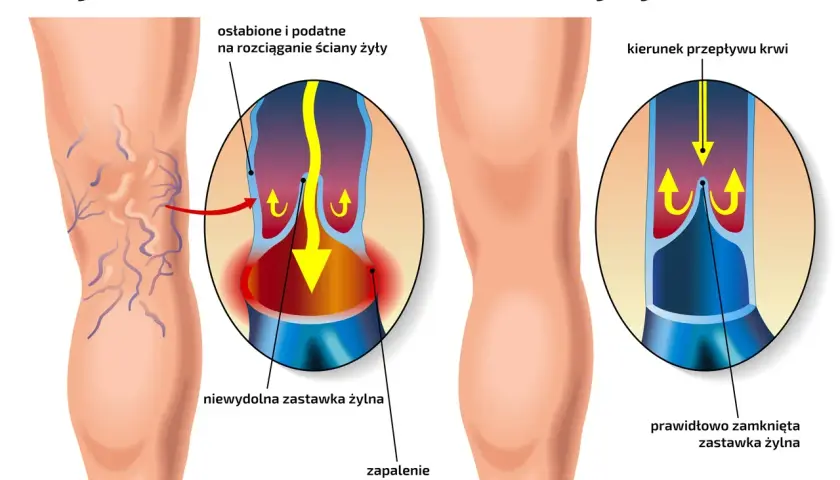 Porównanie nóg z żylakami i zdrowych. Ilustracja pokazuje, jak bieganie wpływa na żyły, zapobiegając powstawaniu żylaków.