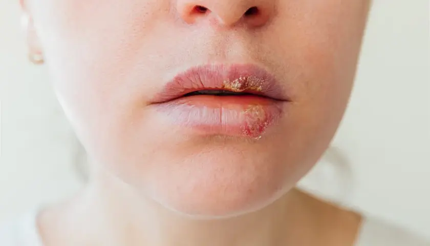 Labbra con lesioni erpetiche. Le vescicole e le croste indicano la fase attiva, ma quanto dura l'herpes?