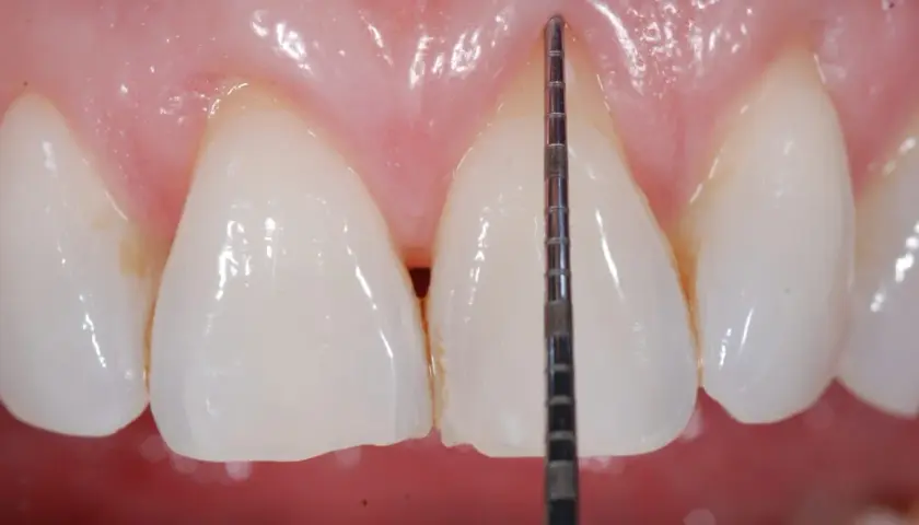 Misurazione della profondità gengivale con sonda parodontale. La recessione gengivale è un problema da non sottovalutare.