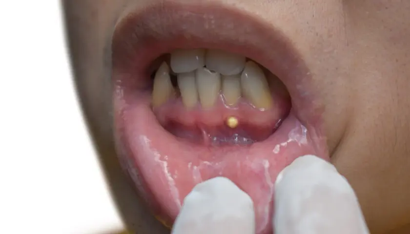 Pequeña protuberancia amarilla en la encía, posiblemente un quiste gingival, examinada con guantes.
