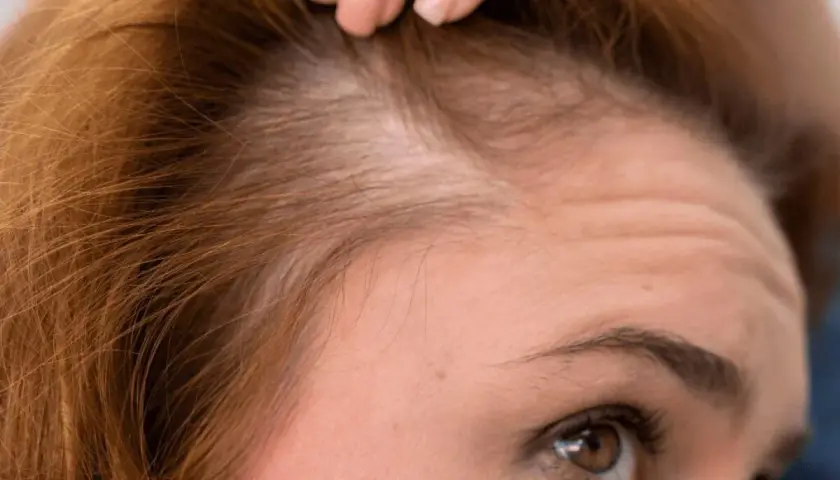 Primer plano de una mujer revisando su cuero cabelludo, preocupada por evitar la caída del cabello.