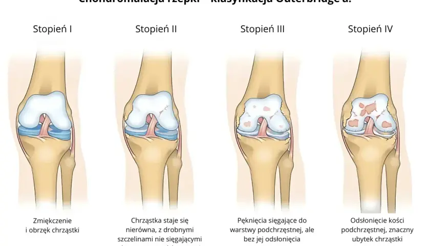 Ilustracja pokazuje cztery stopnie chondromalacji rzepki wg klasyfikacji Outerbridge'a: od zmiękczenia chrząstki do odsłonięcia kości.