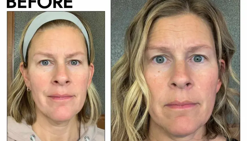 Före- och efterbilder på en kvinna. Hennes hud ser klarare ut efter behandlingen, som om hon lyckats dra ut pormaskar med pincett.