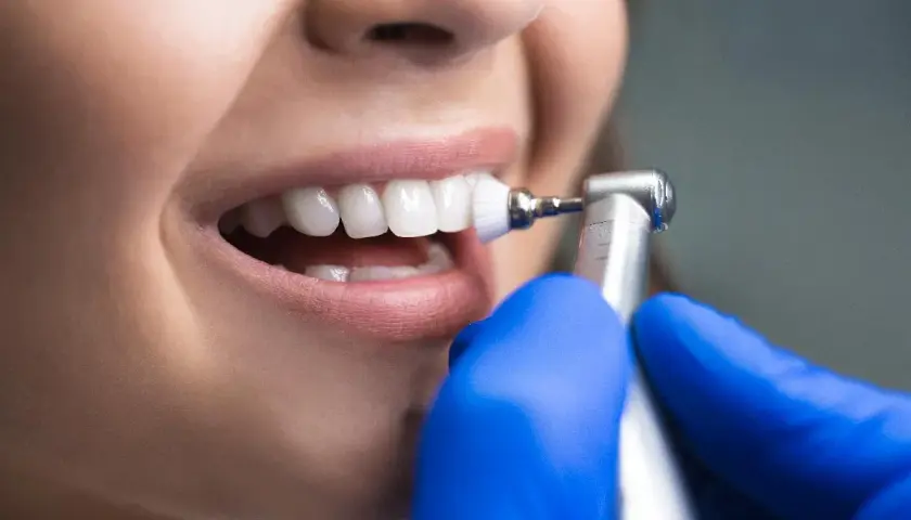 Denti bianchi e sani dopo la detartrasi ultrasuoni. Un dentista con guanti blu pulisce i denti con uno strumento rotante.