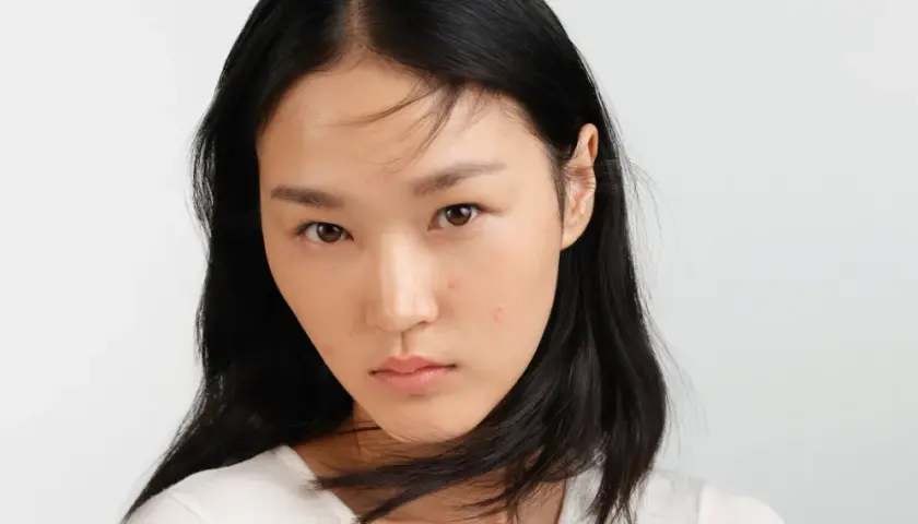 Jeune femme au visage marqué par des imperfections. Elle cherche des solutions sur que faire contre la peau grasse.