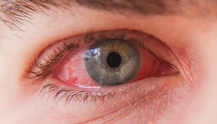 Œil rouge et irrité, signe de conjonctivite. Un traitement est nécessaire pour soulager l'inflammation.