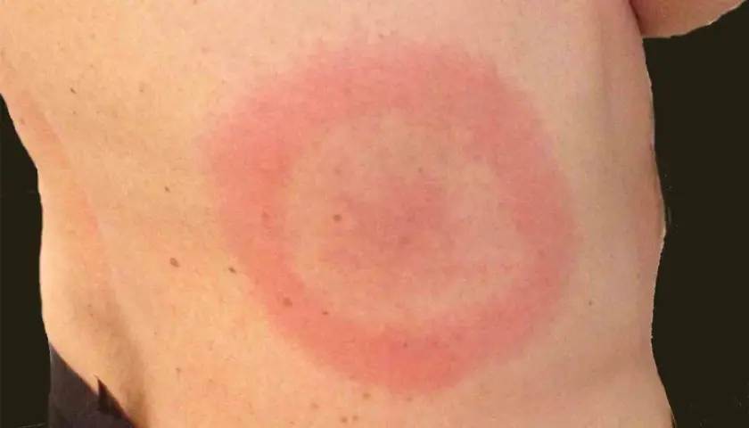 Rött, ringformat utslag på huden, misstänkt allergiska utslag.