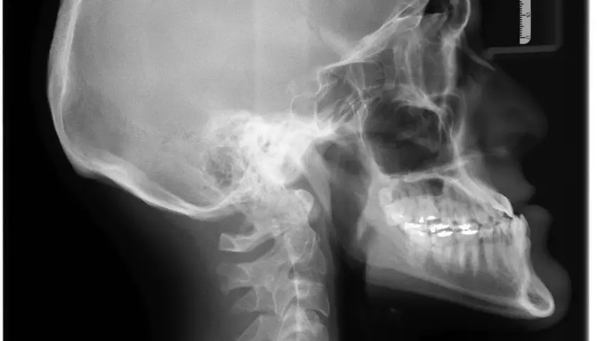 Radiografia czaszki w profilu, ukazująca kości czaszki, kręgosłup szyjny i uzębienie. Promieniowanie rentgenowskie pozwala zobaczyć strukturę kości.