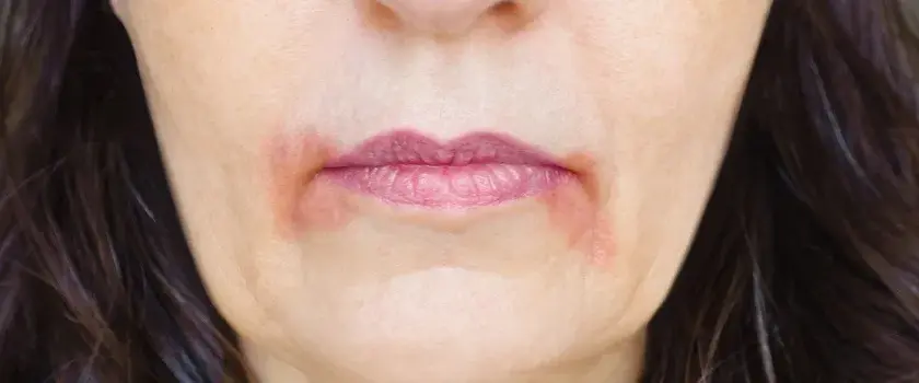 Zapalenie Wokół Ust: Zrozum Dermatozę Okołoustną, Zdjęcia i Leczenie Zapalenia Skóry