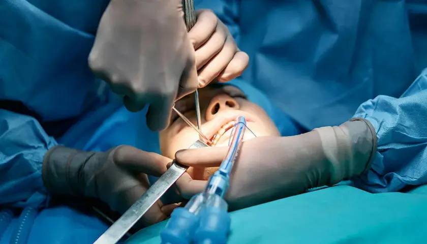 Procedimiento dental con anestesia general para extracción de muelas del juicio. Cirujanos operan la boca de un paciente.