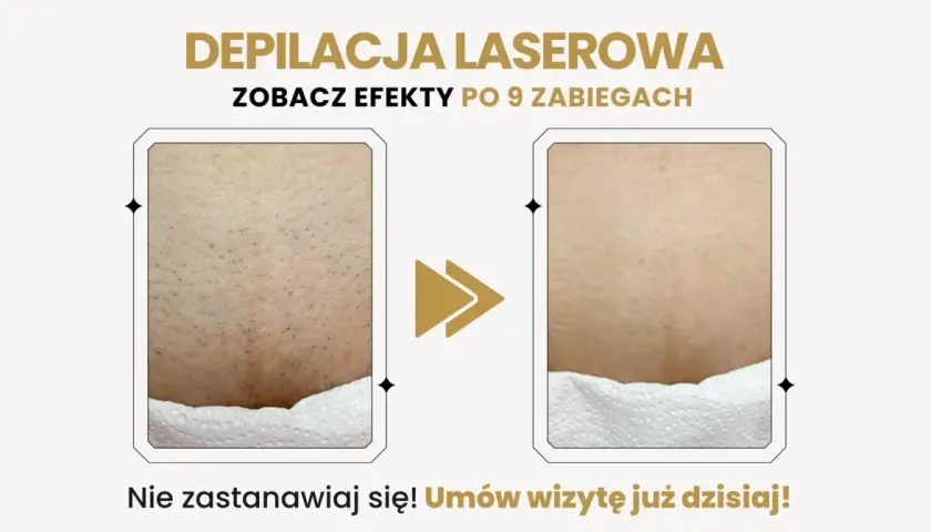 Porównanie skóry przed i po depilacji laserowej bikini.