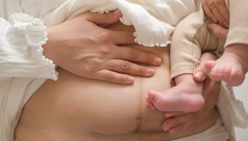Brzuszek mamy z widocznymi zrostami po cc, otulony delikatnym materiałem, z maleńką stópką dziecka.