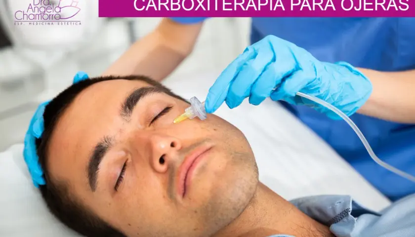 Un profesional aplica carboxiterapia para ojeras a un hombre. El tratamiento mejora la apariencia de la piel.