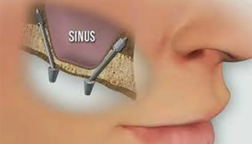 Illustrazione di un sinus lift: due impianti dentali inseriti nell'osso mascellare superiore, vicino al seno mascellare.