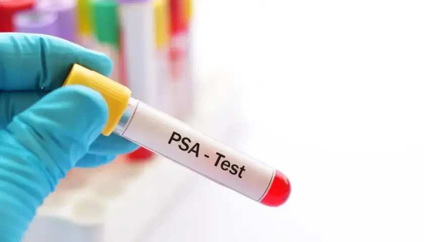 Rękawiczka trzyma probówkę z napisem "PSA - Test". To badanie psa, które pozwala ocenić jego stan zdrowia.