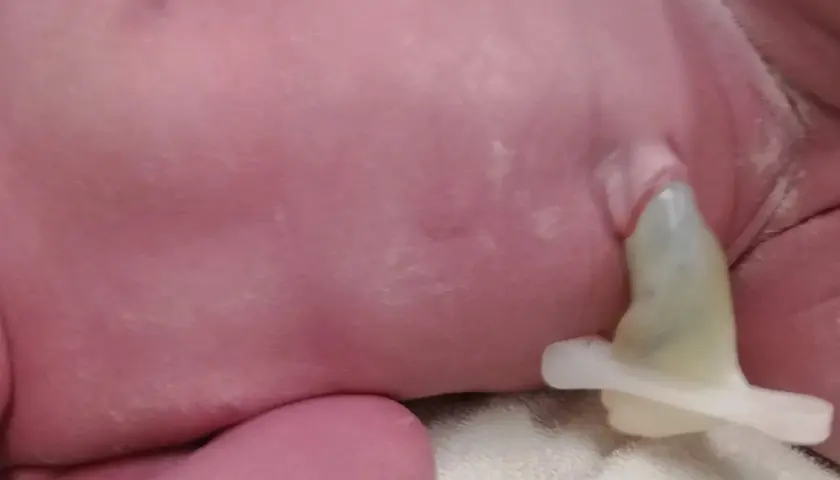 Kikut pępowinowy u noworodka, zabezpieczony klipsem. Zastanawiasz się, po jakim czasie odpada pępek u noworodka? Zwykle dzieje się to w ciągu 1-3 tygodni.