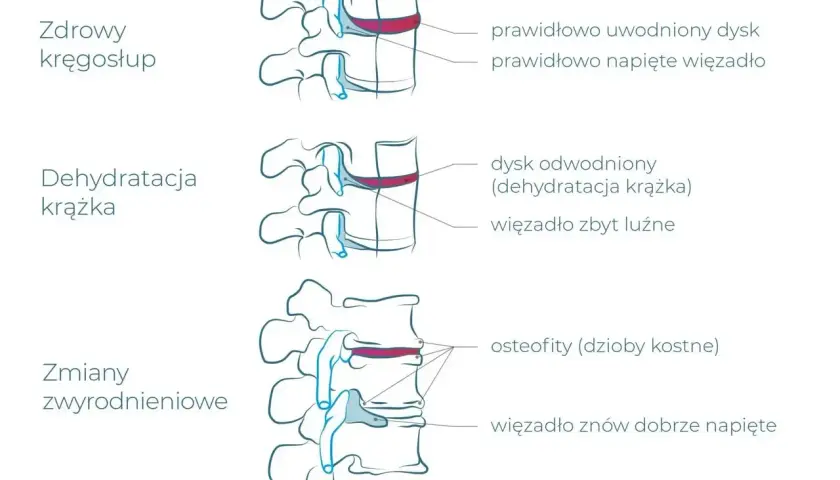 Ilustracja pokazuje zdrowe kręgi, odwodniony krążek i zmiany zwyrodnieniowe, które mogą być spowodowane pracą fizyczną.