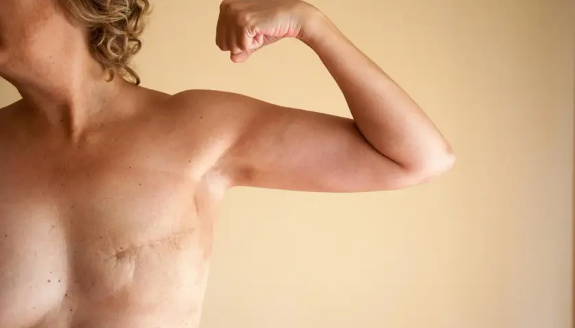 Silna kobieta po mastektomii piersi pokazuje bliznę i biceps. Siła i odwaga po walce.