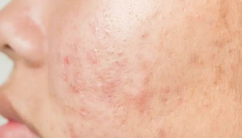 Gros plan sur une peau présentant des rougeurs et des imperfections, illustrant la cause de l'acné sur le visage.